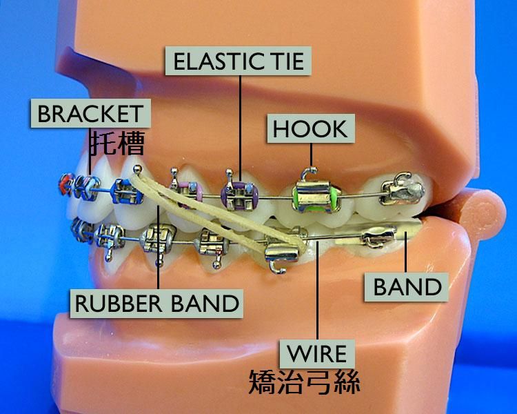 photo bracesdiagramedited.jpg