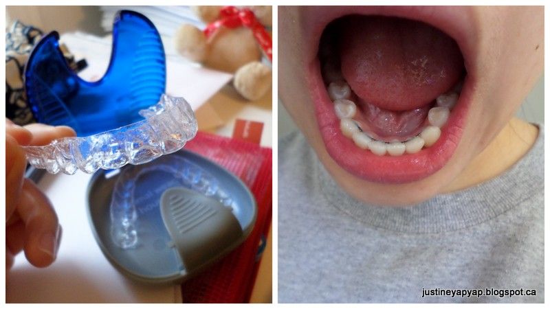  photo bracesofffirstwhitening1.jpg